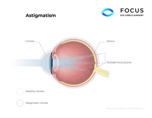 astigmatism diagram