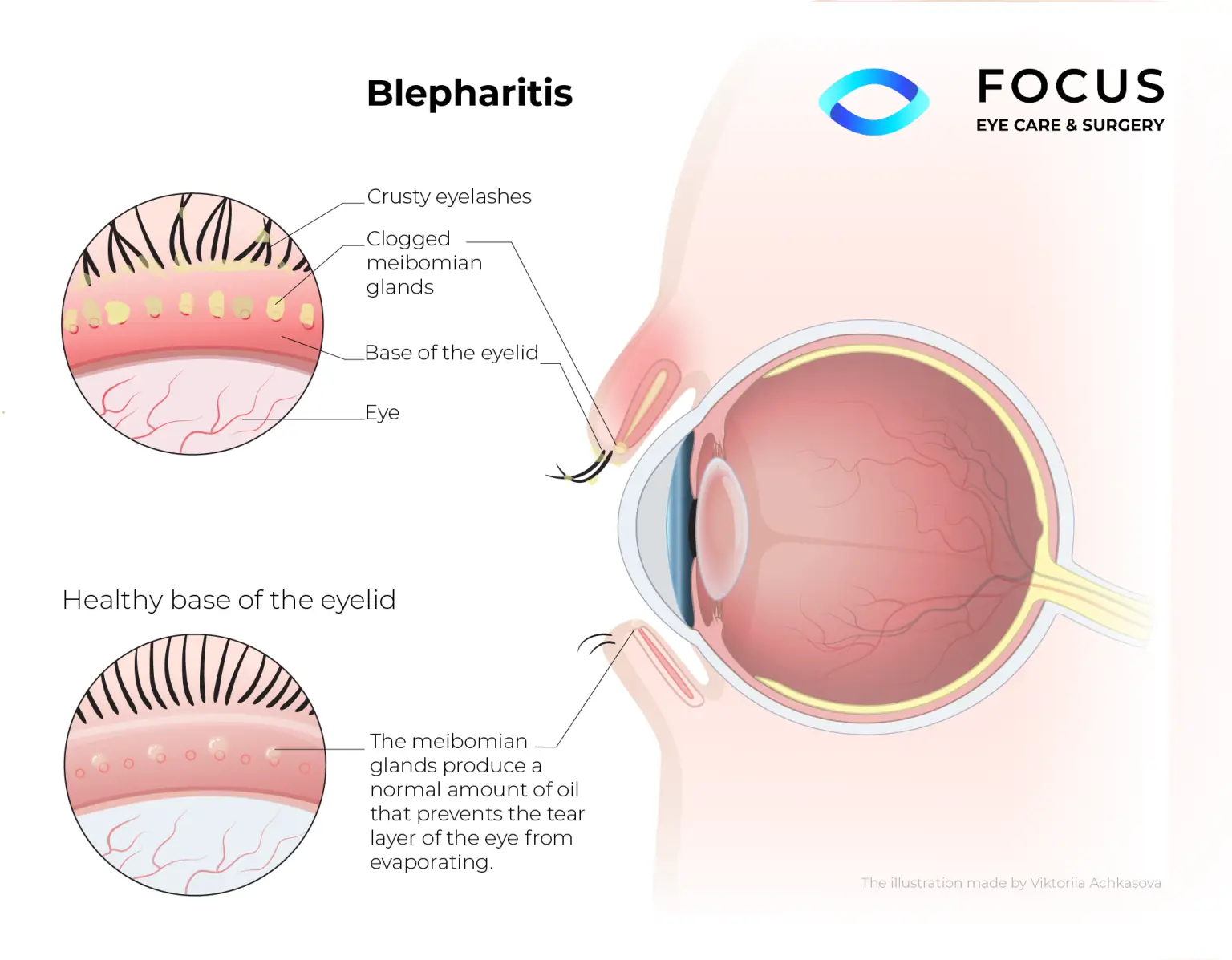 blepharitis diagram