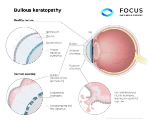 bullous keratopathy diagram