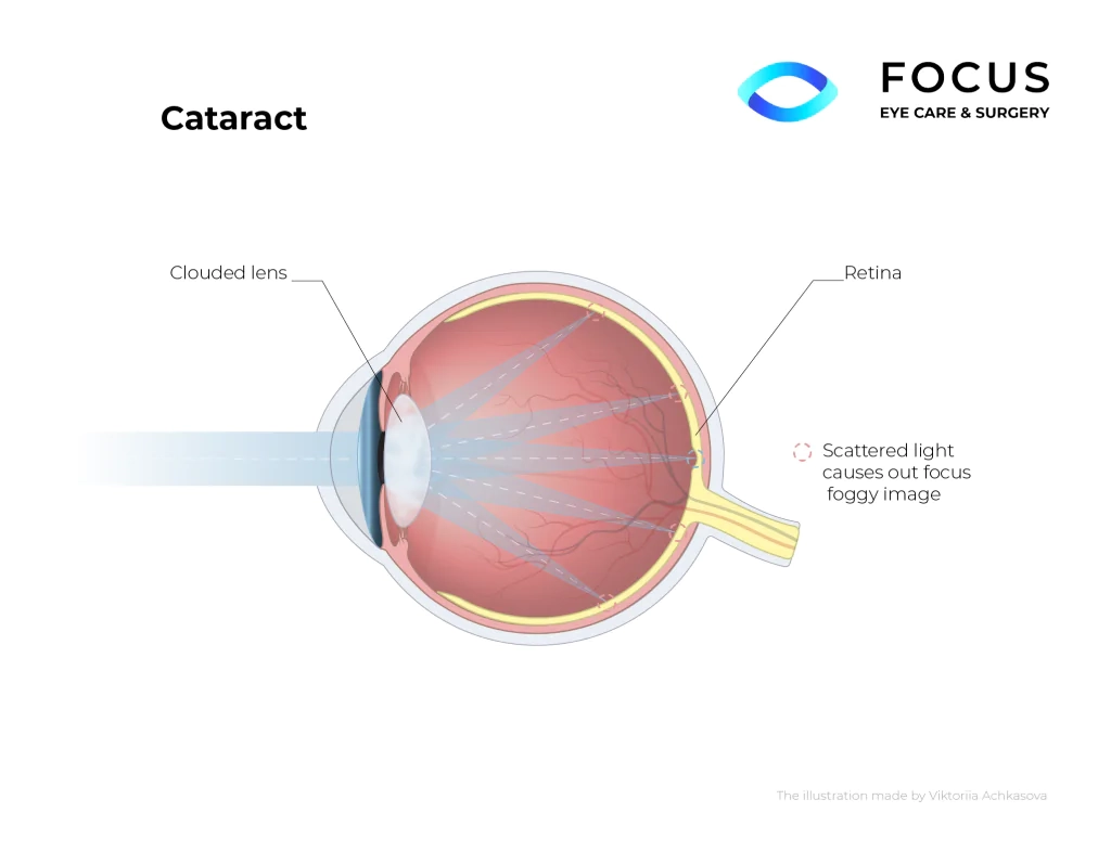 cataract diagram