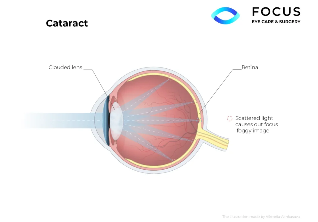 cataract diagram