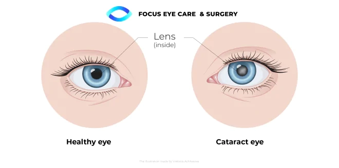 cataract eye lens