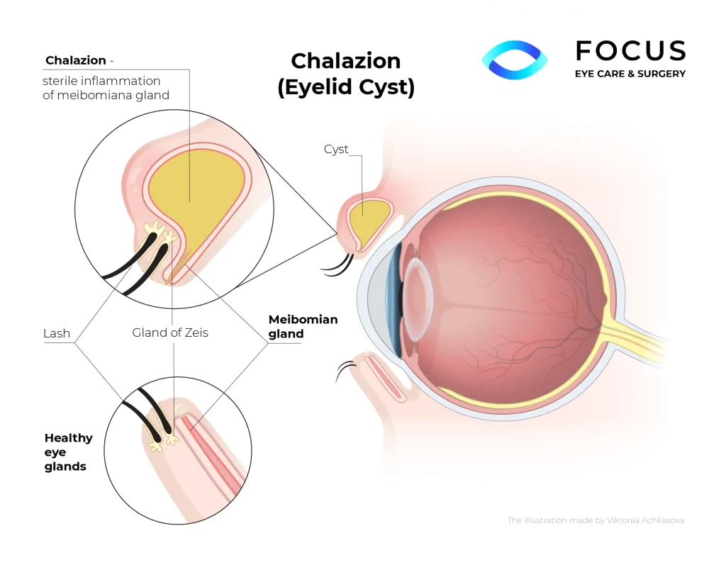 chalazion diagram