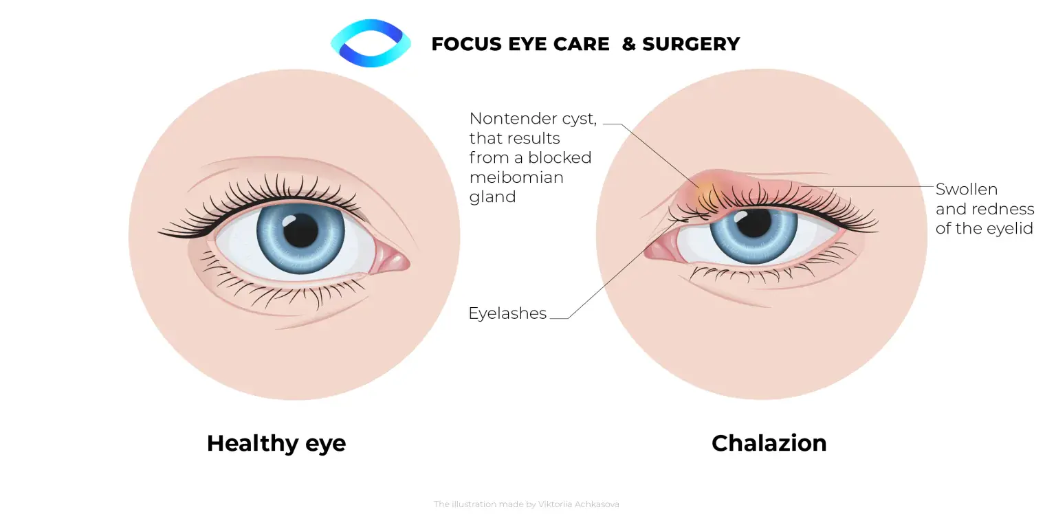 chalazion diagram