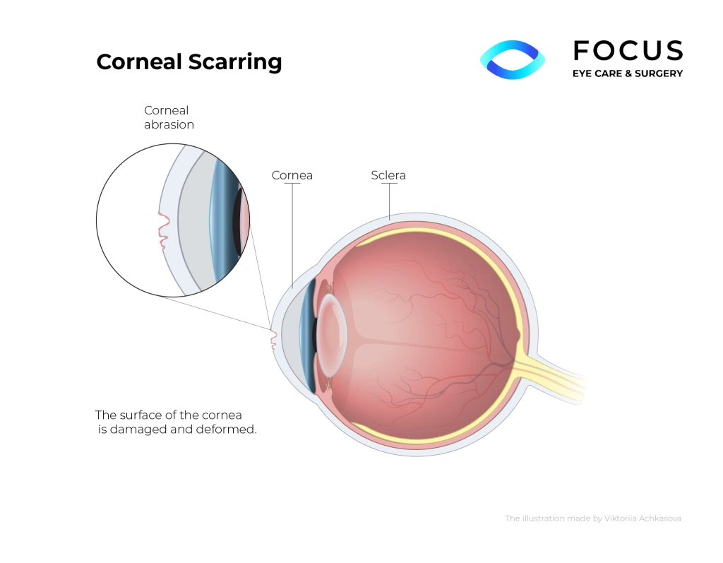 corneal scarring diagram