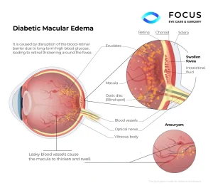 diabetic macular edema diagram