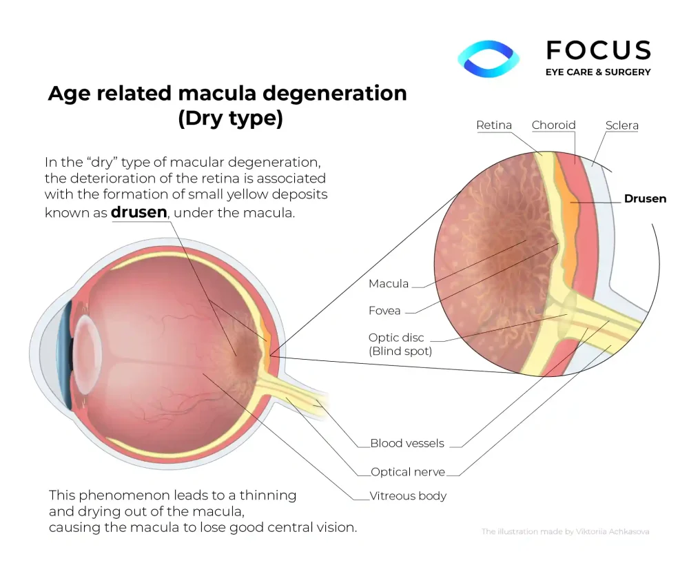 Dry AMD diagram