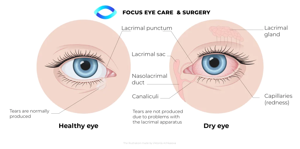 dry eye diagram