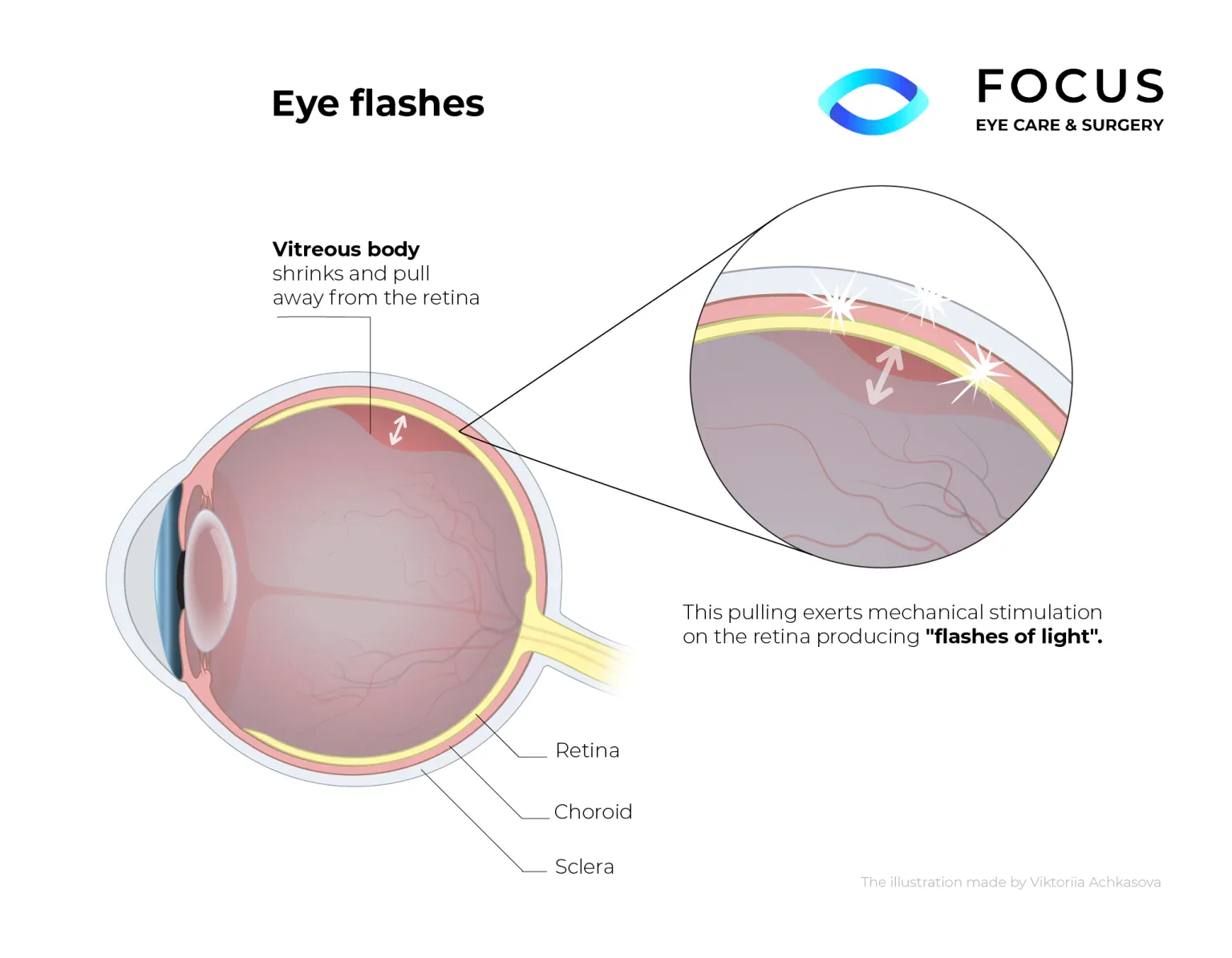 eye flashes diagram