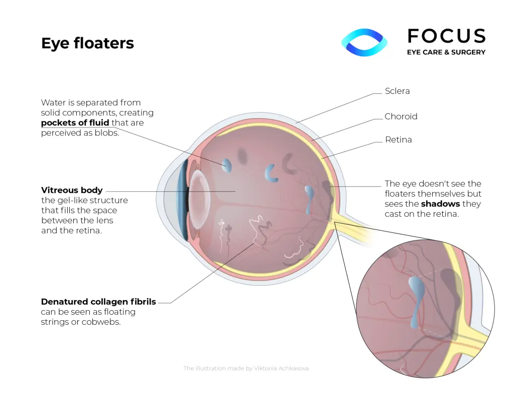 eye floaters diagram