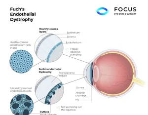 fuchs dystrophy diagram