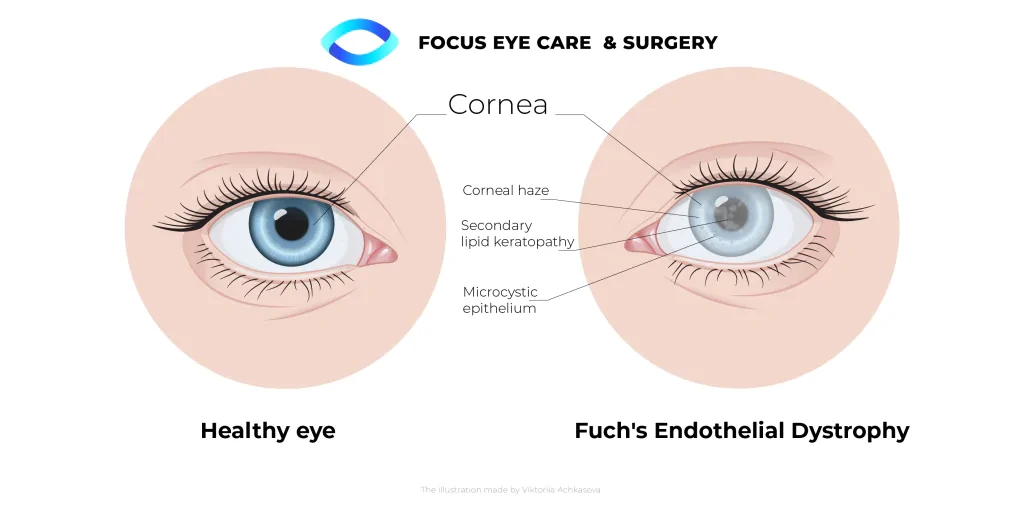 fuchs dystrophy diagram