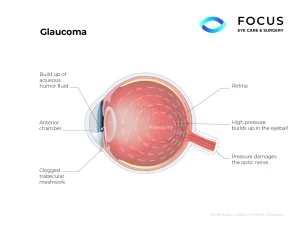 glaucoma diagram