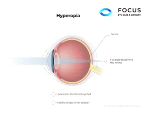 hyperopia diagram