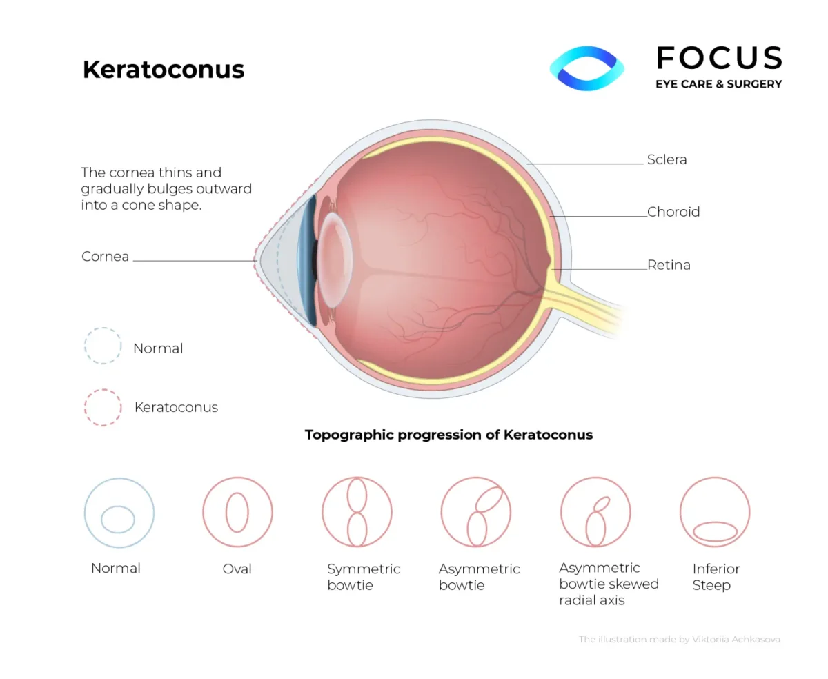 keratoconus diagram