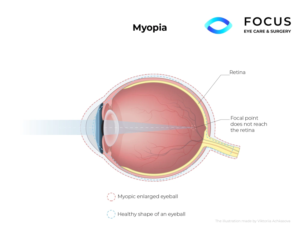 myopia diagram