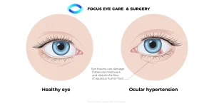 ocular hypertension diagram