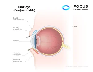 pink eye diagram