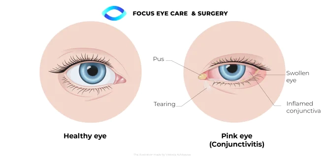 pink eye diagram