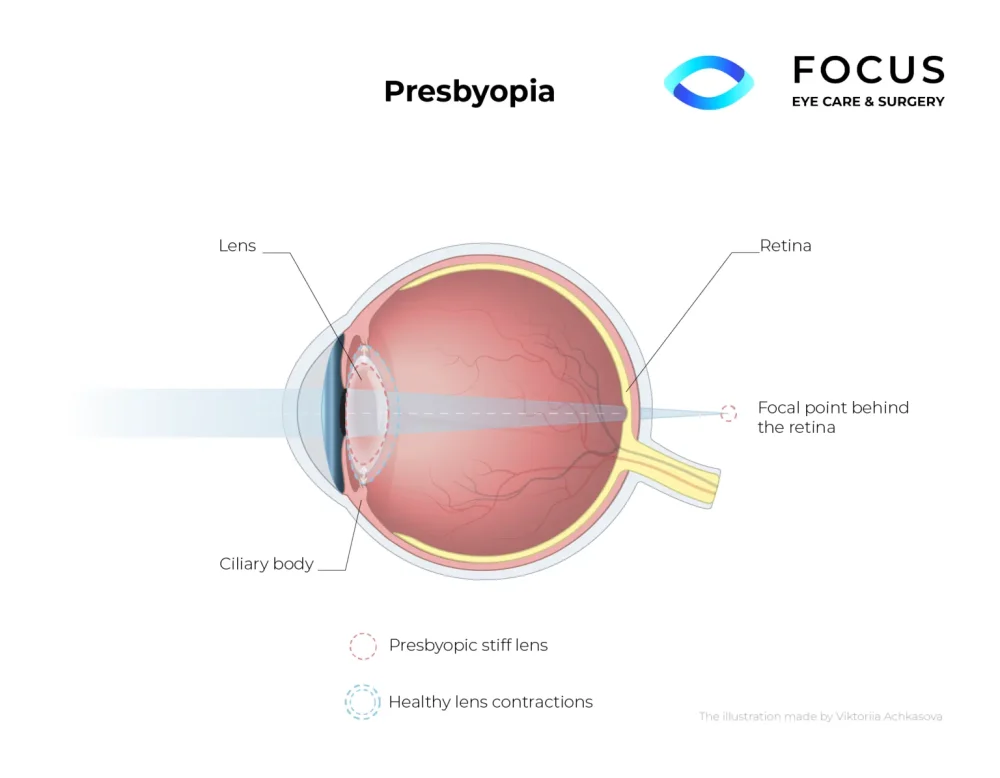 presbyopia