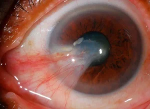 pterygium eye