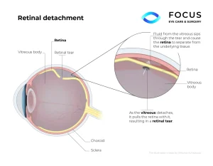 retinal detachment diagram