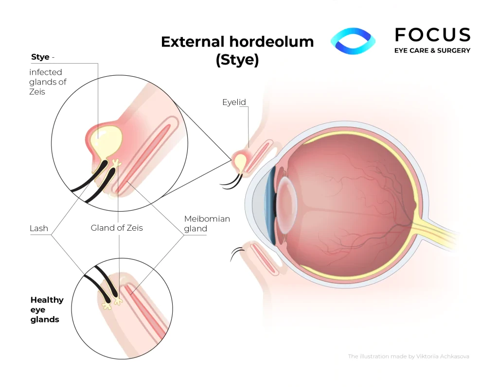 stye diagram