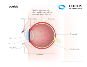 uveitis diagram