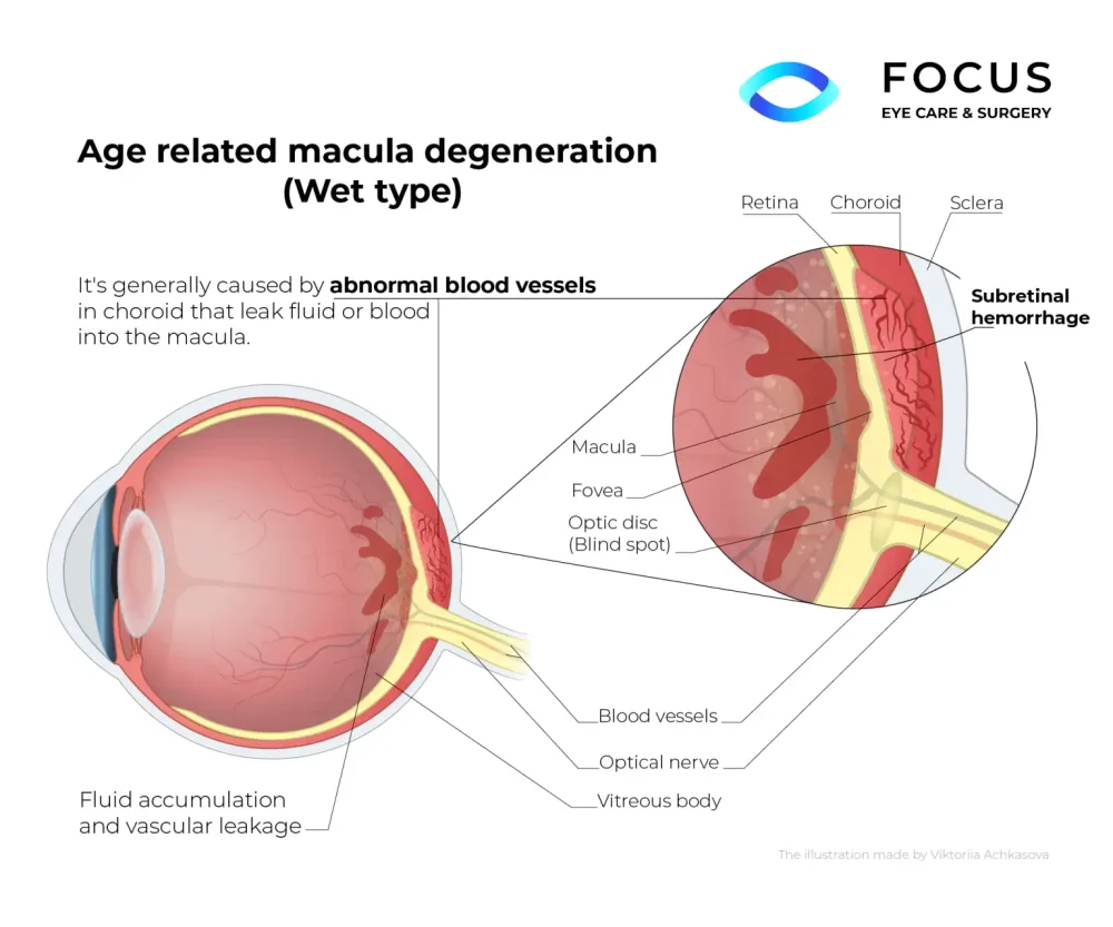 Wet AMD diagram